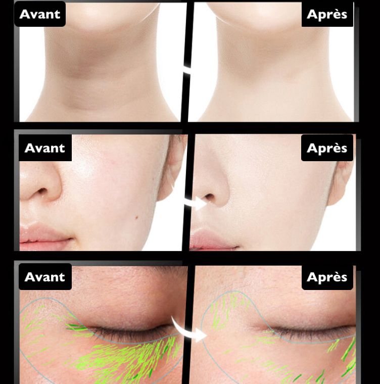 Ninalo™ - Masseur lifting facial à microcourants